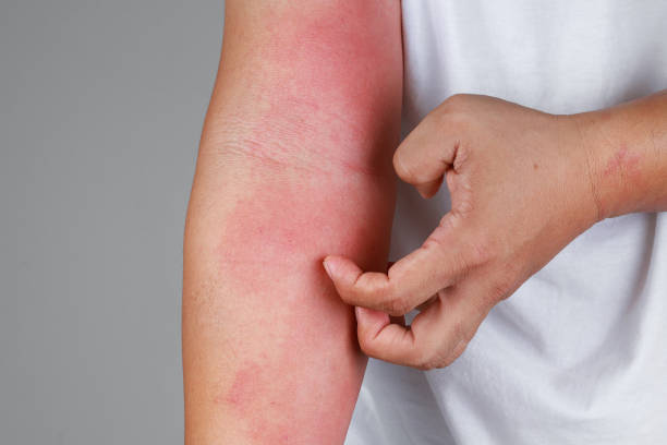 a close up of bad psoriasis on a person's arm